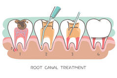 牙根管治疗牙