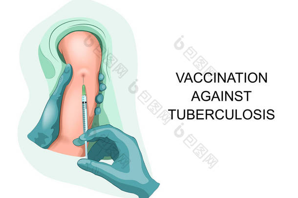 儿童<strong>结核病</strong>疫苗接种例证.