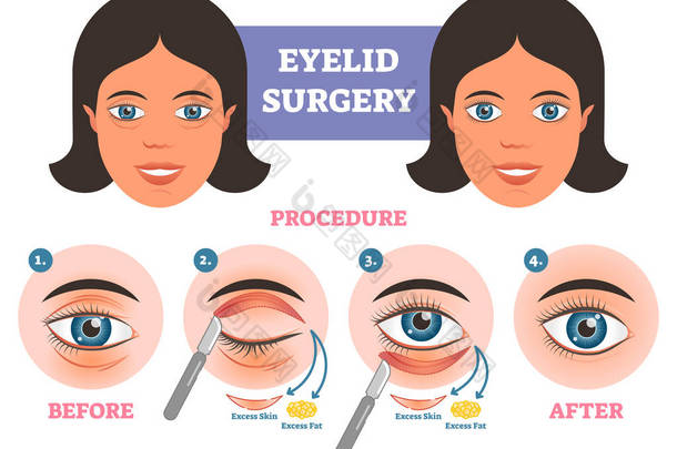 <strong>眼睑</strong>手术前术后 illuatration 与主要步骤。多余的皮肤和脂肪去除.