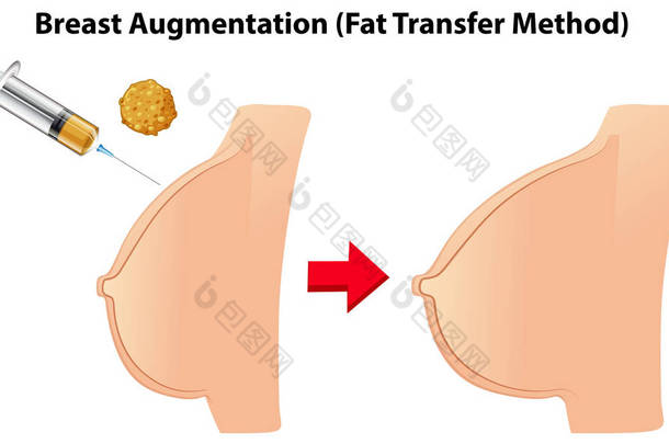 丰胸脂肪<strong>转移</strong>方法例证