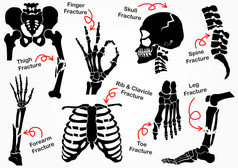 设置骨裂图标 （ Pelvic， 臀部， 大腿 （ 股骨）， 手， 手腕， 手指， 骷髅， 脸， 椎骨， 手臂， 肘部， 索拉克斯， 脚， 脚跟， 腿） 黑色和白色设计 （医疗保健概念 )