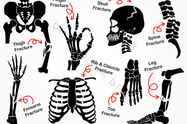 设置骨裂图标 （ Pelvic， 臀部， 大腿 （ 股骨）， 手， 手腕， 手指， 骷髅， 脸， 椎骨， 手臂， 肘部， 索拉克斯， 脚， 脚跟， 腿） 黑色和白色设计 （医疗保健概念 )