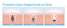 清洁面部堵塞的毛孔。
