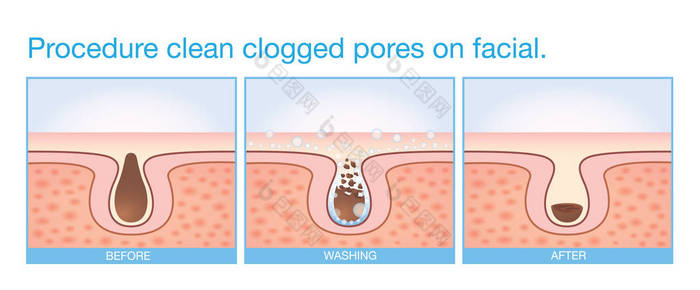 清洁面部堵塞的毛孔。