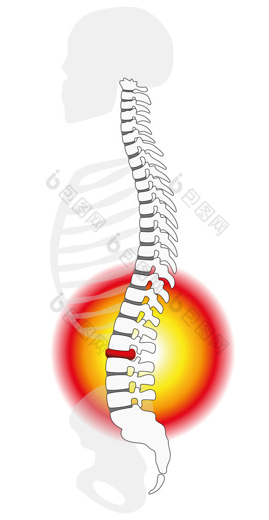 脊柱椎间盘脱出