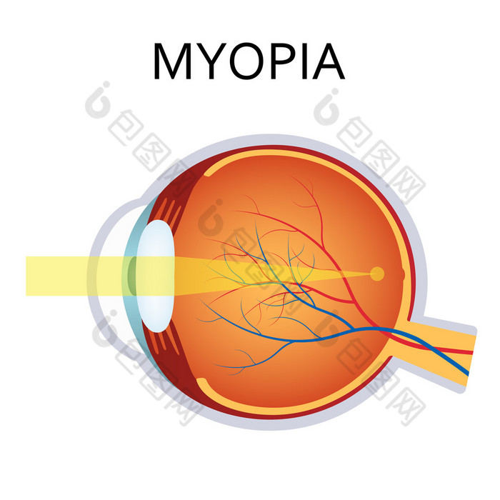 近视。近视是短视.