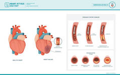 心脏病和动脉粥样硬化的医学插图