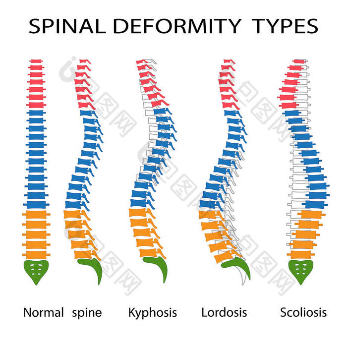 脊柱畸形类型.