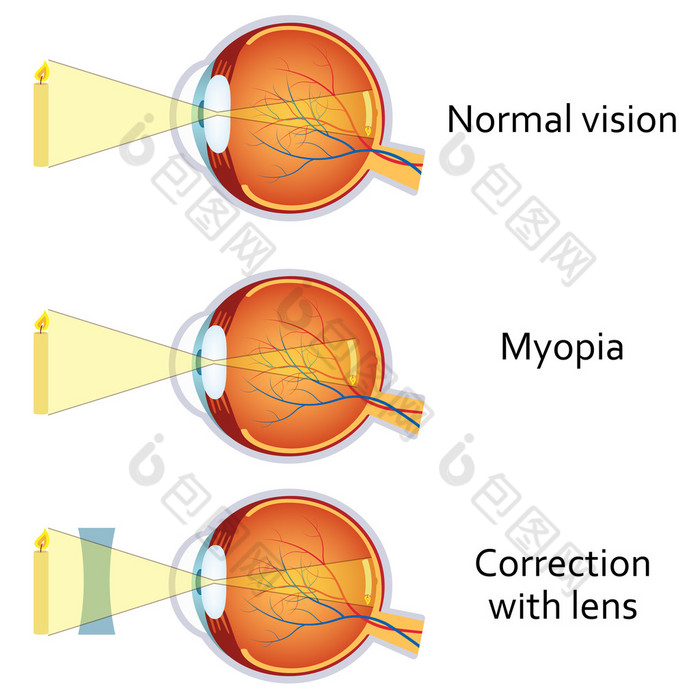 近视和近视由负透镜更正.