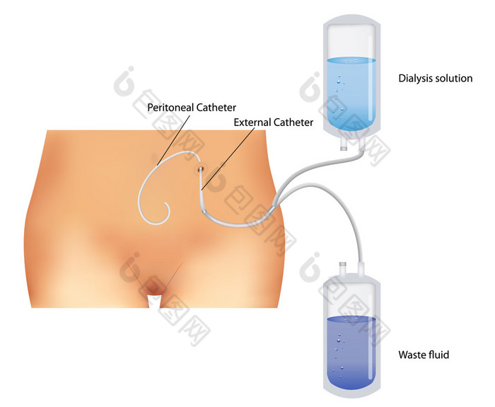 腹膜透析。肾功能不全.