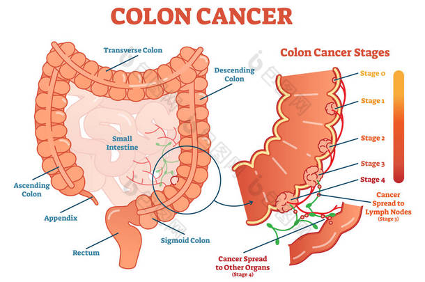 结肠癌医学<strong>图示</strong>方案、肿瘤分期解剖图