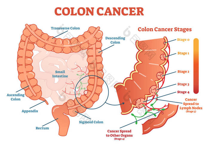 结肠癌医学图示方案、肿瘤分期解剖图