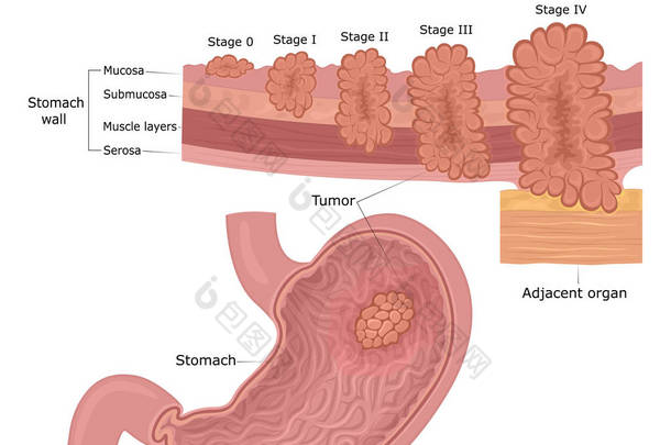 五发展的阶段肿瘤疾病-胃的癌症