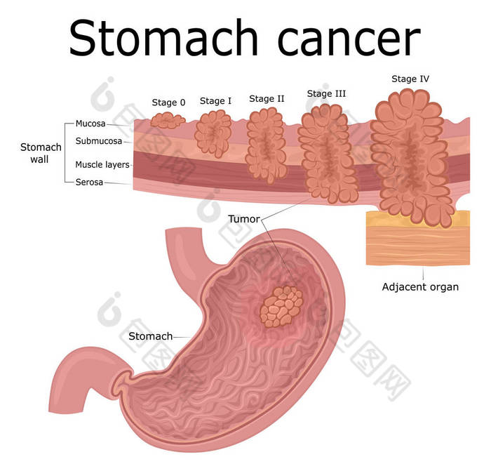 五发展的阶段肿瘤疾病-胃的癌症