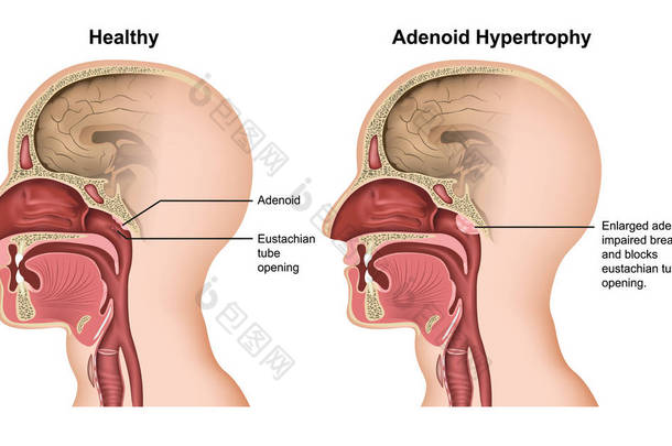 腺样体肥大医学媒介例证在白色背景