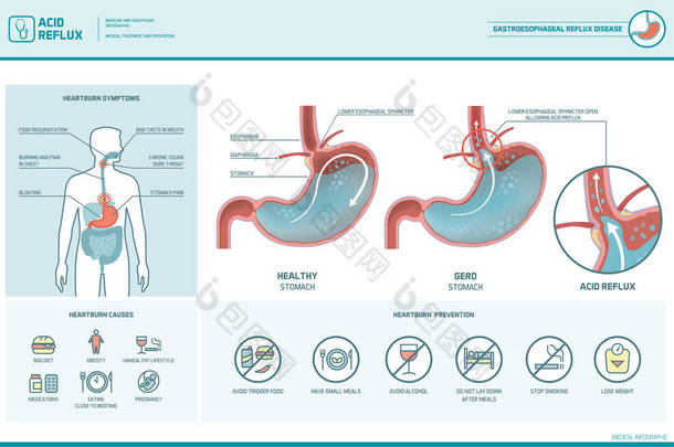 酸反流和<strong>胃</strong>灼热图