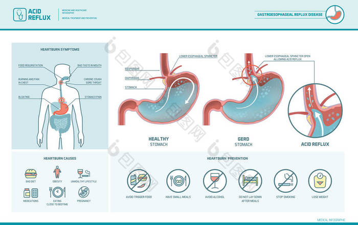 酸反流和胃灼热图肠胃 脾胃