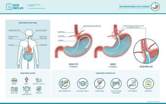 酸反流和胃灼热图图片