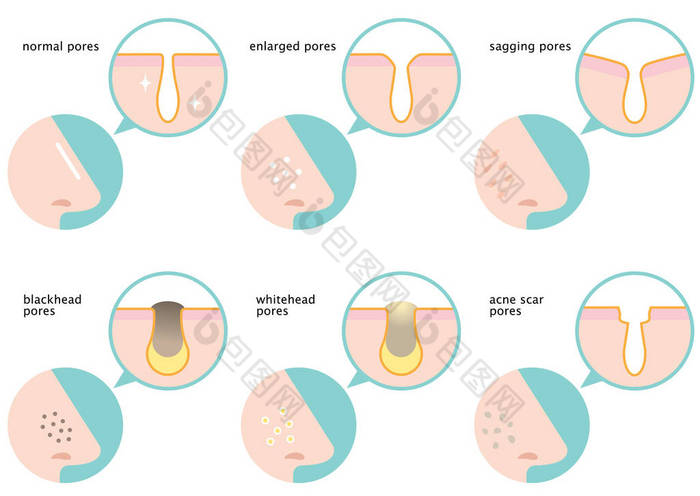鼻部皮肤毛孔集: 正常、下垂、肿大、黑头、白石、痤疮疤痕