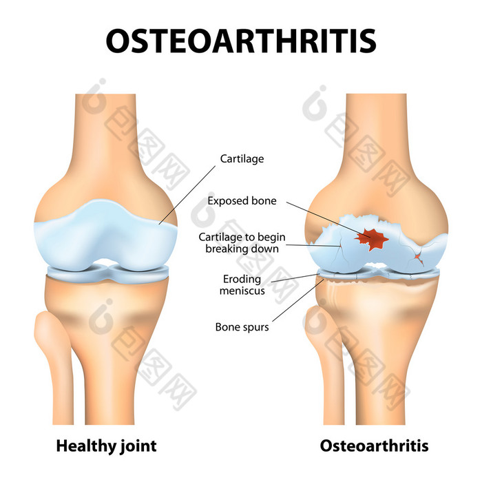 骨关节炎还是关节炎