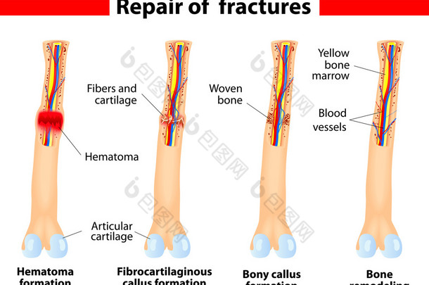 骨骨折愈合过程