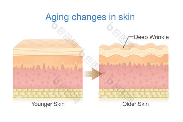 皮肤的衰老变化