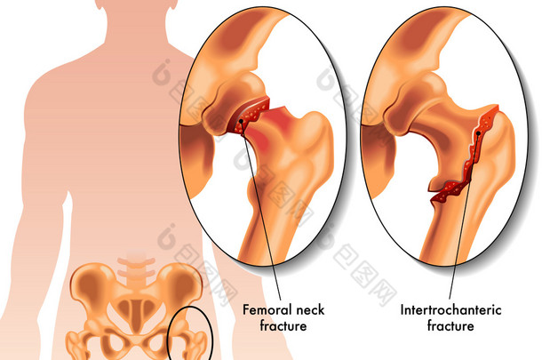 人类股骨<strong>骨折</strong>