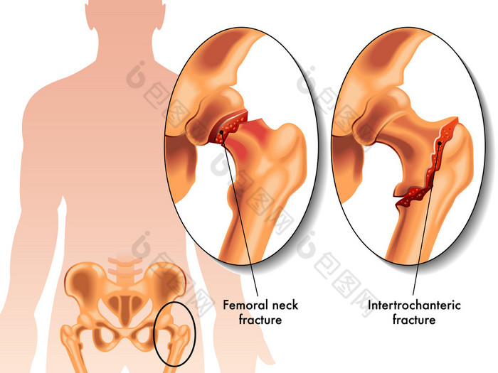人类股骨骨折 骨质疏松
