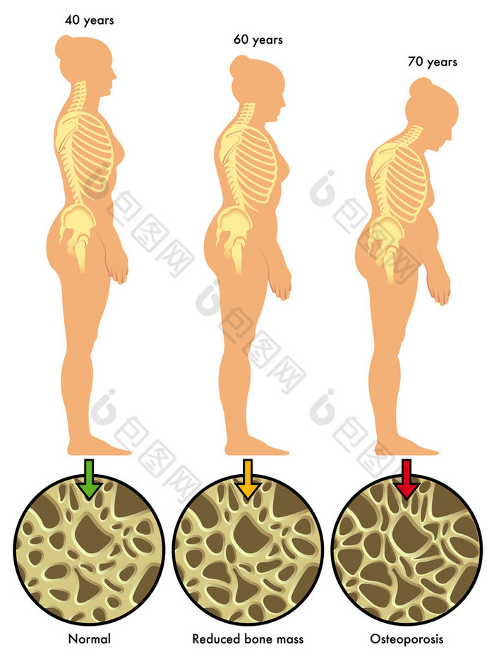 多彩的骨质疏松症计划