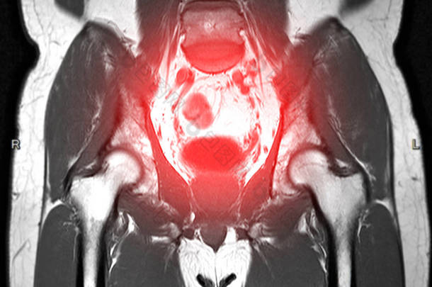 下腹冠状平面T2技术检测<strong>子宫</strong>肌瘤.
