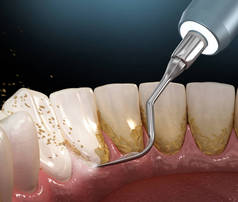 口腔卫生：超声波牙齿清洗机去除微积分和斑块。人体牙齿治疗的医学精确三维插图