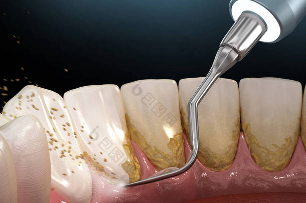 口腔卫生：<strong>超声波</strong>牙齿<strong>清洗机</strong>去除微积分和斑块。人体牙齿治疗的医学精确三维插图