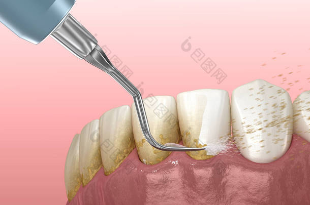 口腔卫生：烫伤和根部修整（<strong>常规</strong>牙周病治疗） 。医学上准确的人类牙齿治疗三维图像