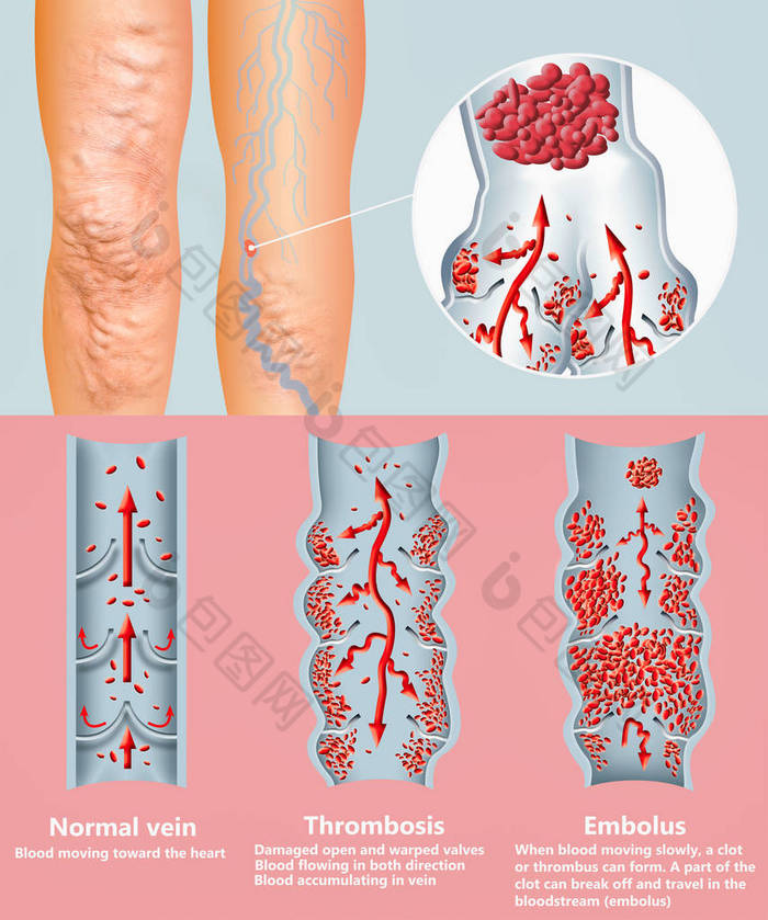 深静脉血栓形成或血块。栓子.