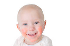 食物过敏概念-婴儿与皮炎在脸颊上