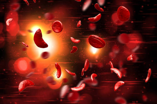 镰状细胞贫血症(SCD)血细胞3D图例