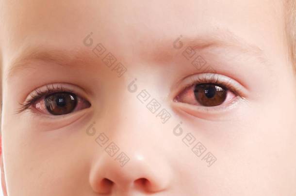 儿童结膜炎红眼感染, 健康.