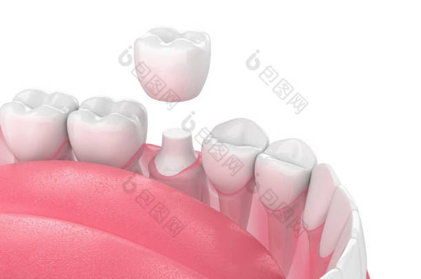 3d. 用牙齿和牙冠<strong>修复</strong>颌骨的渲染