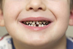 儿童病人张开嘴显示蛀牙牙齿腐烂。关闭不健康的婴儿牙齿。牙科医学和保健-人类患者张开嘴显示蛀牙蛀牙蛀牙