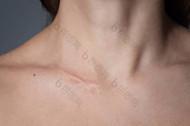 脖子上有手术疤痕的女人. 