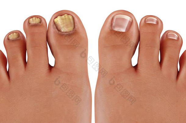 甲真菌病和真菌指甲感染或耳鸣作为受感染的脚趾甲或脚趾指甲, 在3d 插图风格损害不健康和健康的人体解剖.