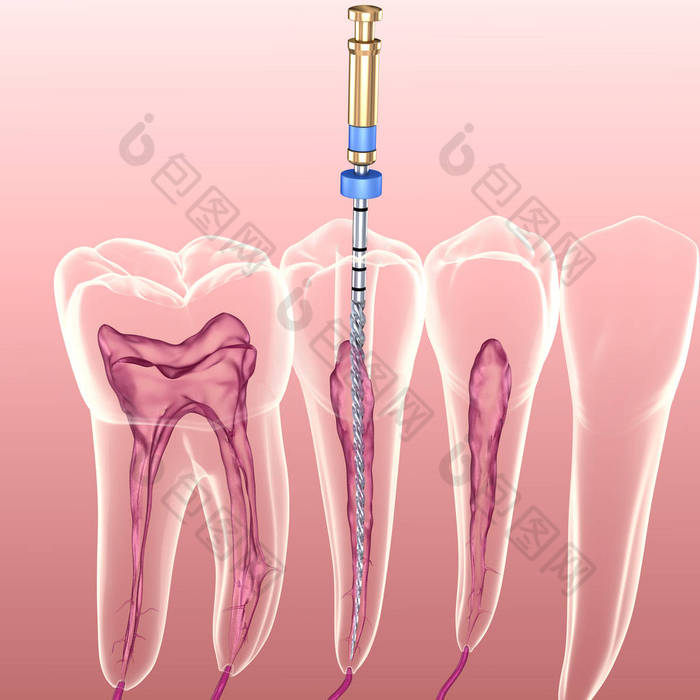 牙内根管治疗过程.医学上准确的牙齿3D图像.