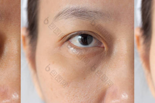三张图片比较治疗前后的<strong>疗效</strong>。 眼底有黑眼圈、眼窝肿胀、眼眶周围皱纹等问题，治疗前后可改善皮肤状况