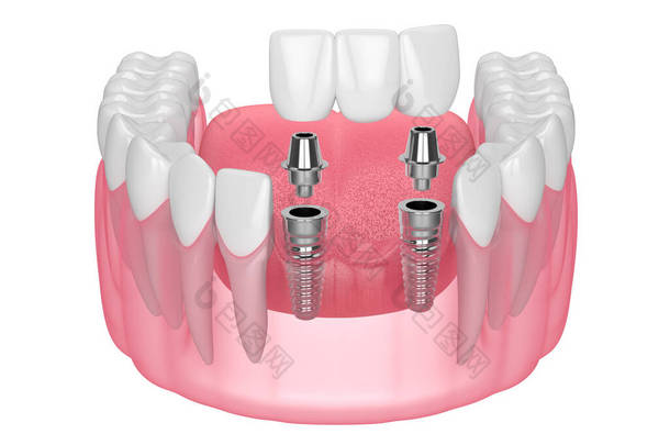 带种植体的<strong>下颌骨</strong>，在白色背景上支撑牙桥