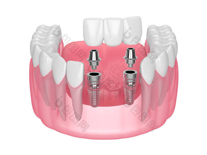 带种植体的下颌骨，在白色背景上支撑牙桥 种植牙