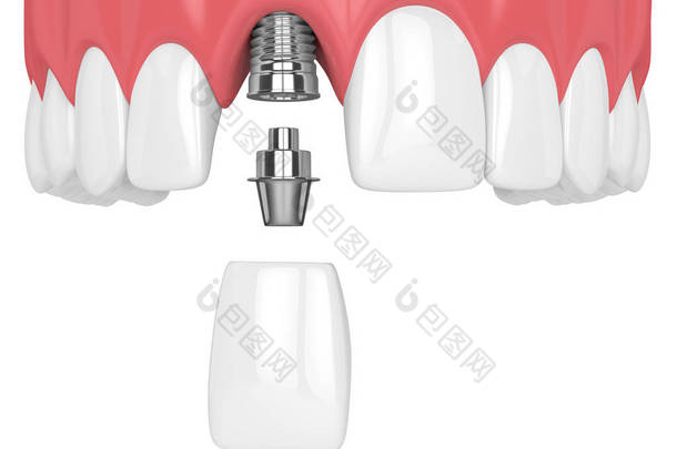 3d. 在白色背景下用牙齿和<strong>门牙</strong>植入上颌下颌