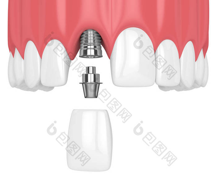 3d. 在白色背景下用牙齿和门牙植入上颌下颌