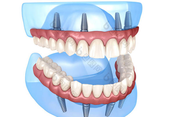 上颌骨和下颌骨假体均在4个系统上，由植入物<strong>支持</strong>。医学上准确的人类牙齿和假牙3D图像