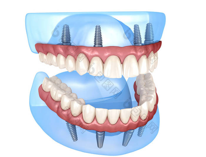 上颌骨和下颌骨假体均在4个系统上，由植入物支持。医学上准确的人类牙齿和假牙3D图像