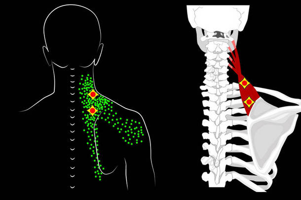左撇子肩关节<strong>肌肉</strong>。 触发点和<strong>肌肉</strong>结构。 颈部和肩部的疼痛.
